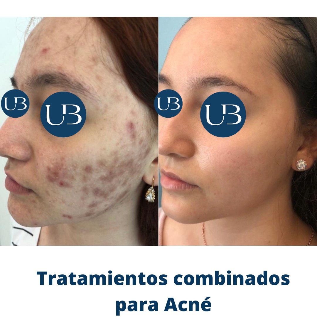 Resultado acné 1