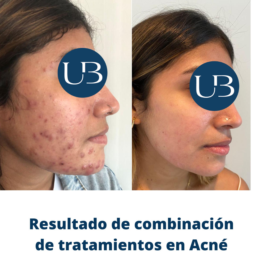 Resultado acné 2