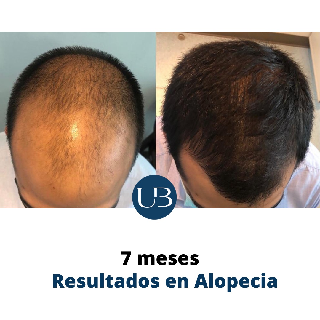 Resultado alopecia 2