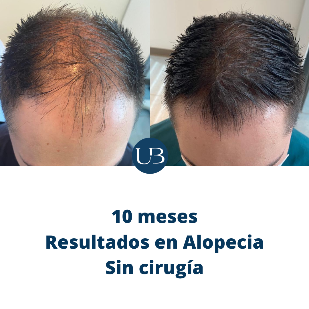Resultado alopecia 3