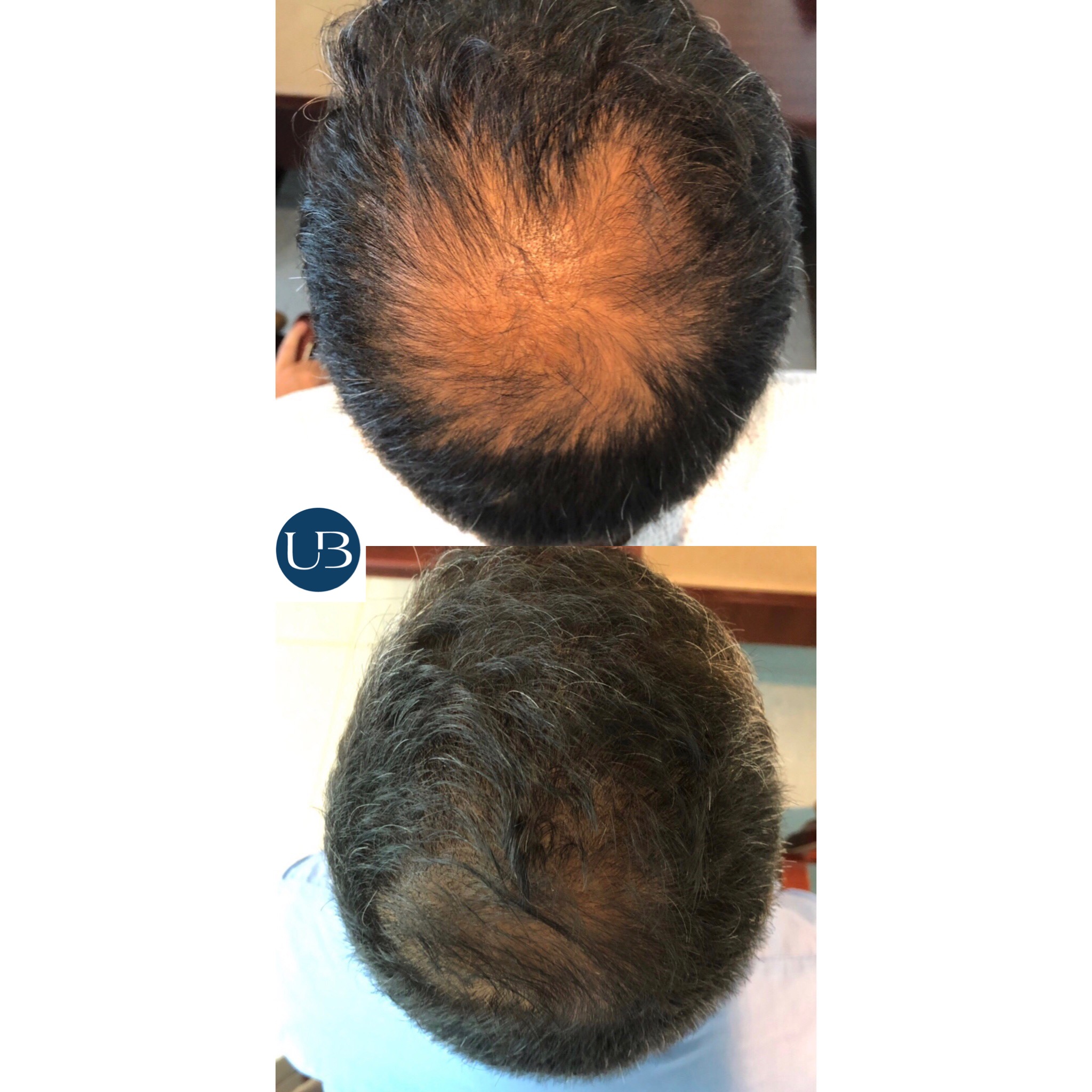 Resultado alopecia 4